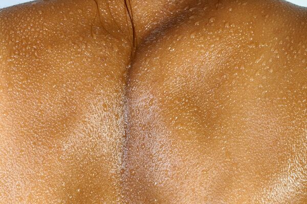 Clear improved skin after acne scar treatment series