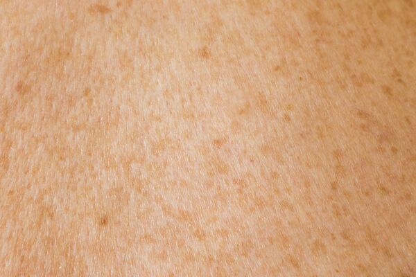 Microneedling targeting acne scars for collagen remodeling