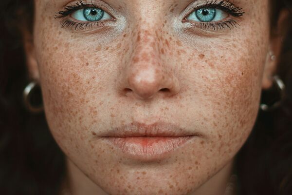 Natural facial expressions preserved after expert Botox