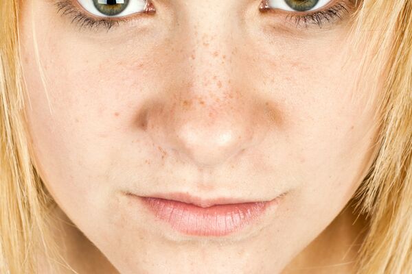 Peak Botox results at two weeks showing smooth forehead