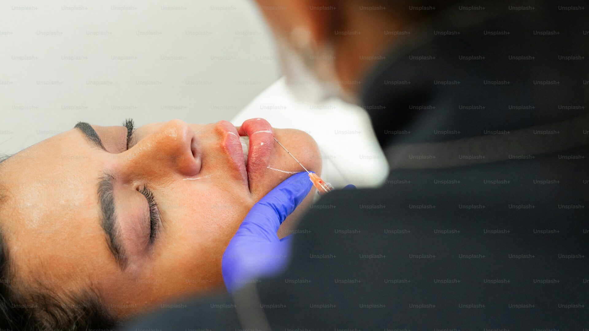 Dermal filler products including Juvederm and Restylane for facial rejuvenation